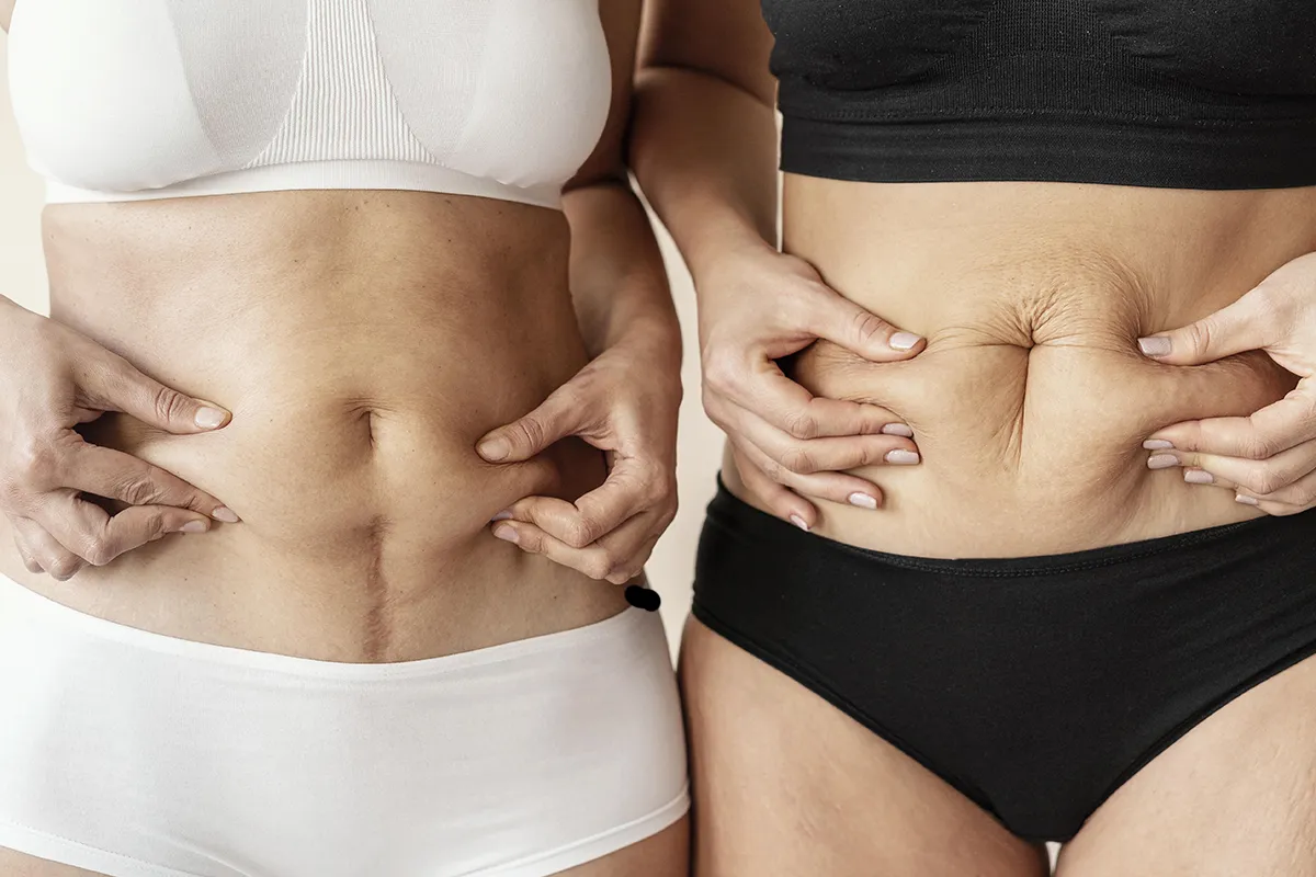 Abdominoplastia faz parte do contorno corporal?
